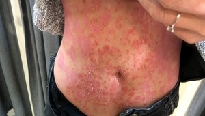 Máte psoriázu? Takto by ste sa mali v lete starať o kožu