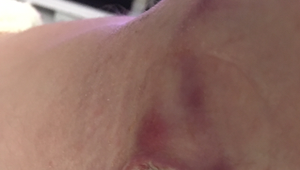 Parazitológ: Exotickú leišmaniózu si pacientka doniesla z Chorvátska!