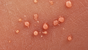 Svrab sa šíri Českom: Viac ako 5 000 nakazených, hygienici bijú na poplach