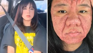 Tehotenstvo jej zničilo peknú tvár: Krásku premenilo na hotové monštrum!