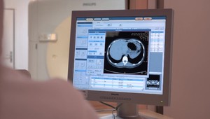 Nová imunoterapia by mohla liečiť rakovinu kostí, naznačuje štúdia