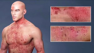 Silné svrbenie a mnohé ťažkosti. Sú choroby, ktoré človek pred okolím ukrývať nedokáže