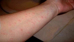 Tretí prípad osýpok na Slovensku potvrdený