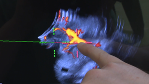 Zázrak po prasknutej aneuryzme. Po náročnej operácii Martina odišla z nemocnice po vlastných