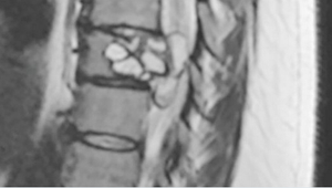 Ženu trápilo tŕpnutie nôh. Lekári našli desivý pôvod jej problémov