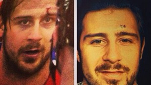 Dvojbodovému Tatarovi pribudlo na tvári päť stehov