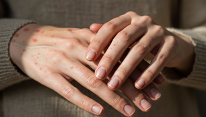 10 vírusových nákaz, pri ktorých sa vám náhle vyhodia vyrážky po tele