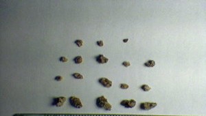 Najhoršia bolesť: 7 spôsobov, ako sa vyhnúť obličkovým kameňom