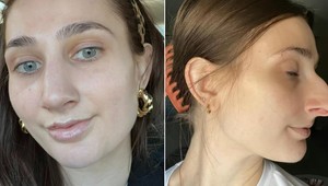 Obrovský nos ako TUKAN jej ničil sebavedomie: Operácia za 10-tisíc jej zmenila život!