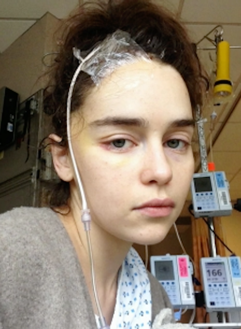 Emilia Clarke - operácia mozgu 4