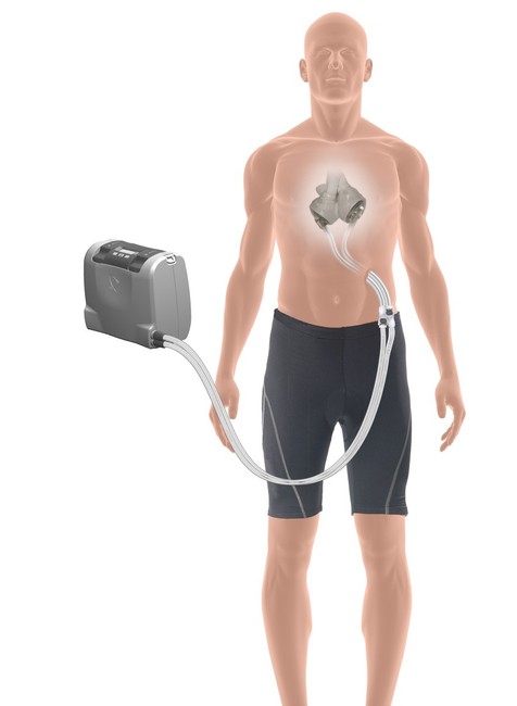 Prvý slovenský pacient s umelým srdcom je už aj po transplantácii srdca