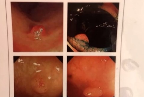 Masívna kampaň bojuje proti rakovine hrubého čreva. Viete ako sa otestovať?