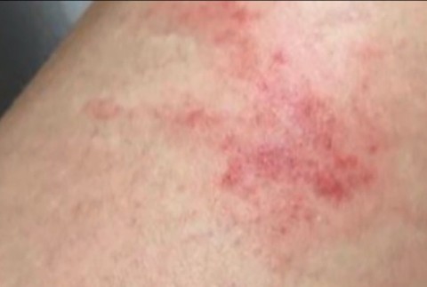 Uštipnutie komárom