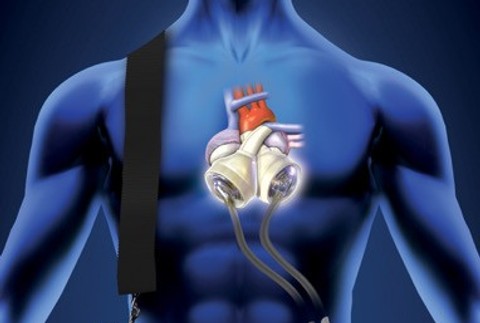 Prvý slovenský pacient s umelým srdcom je už aj po transplantácii srdca