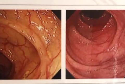 Masívna kampaň bojuje proti rakovine hrubého čreva. Viete ako sa otestovať?