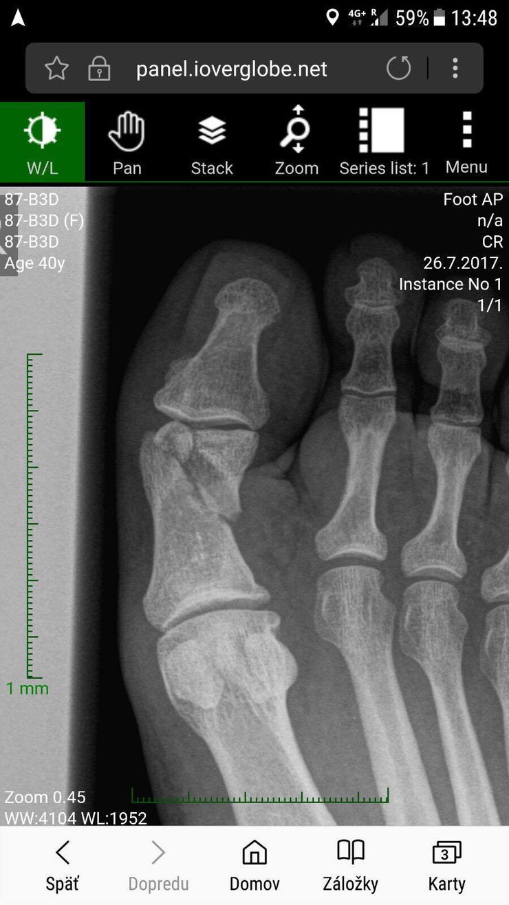 Moja mama - Zuzka Sabolová sa vrátila z dovolenky so zlomeninou