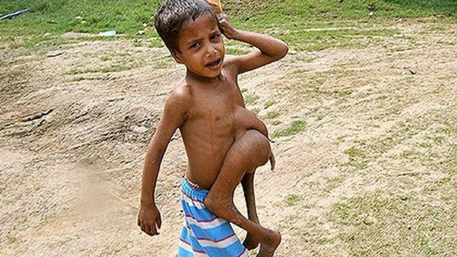 chlapec s parazitickym dvojcatom