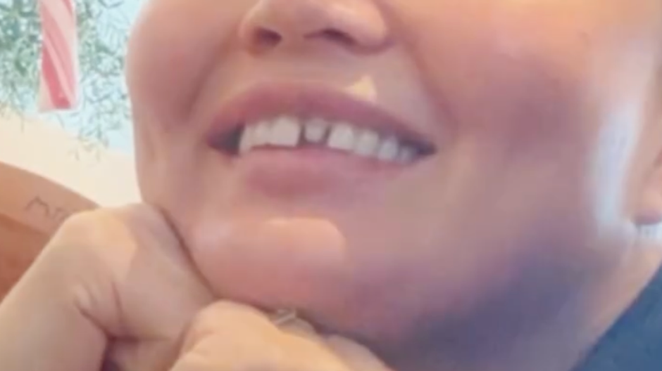 Chrissy Teigen si zlomila zub