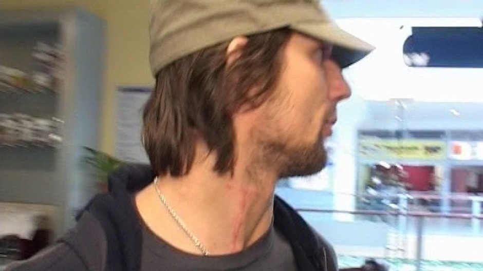 Richard Zedník - jazva po zranení na krku