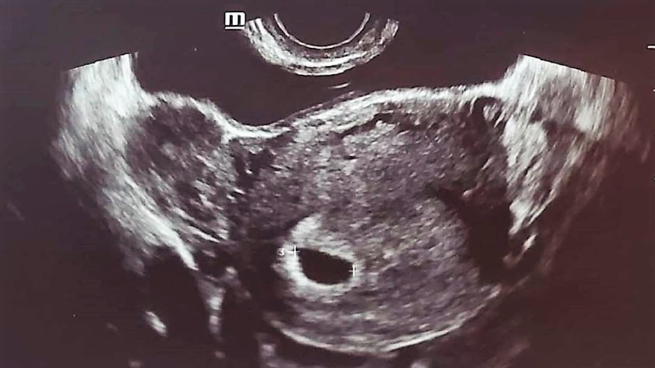 tehotenstvo ultrazvuk Amanda Bynes 