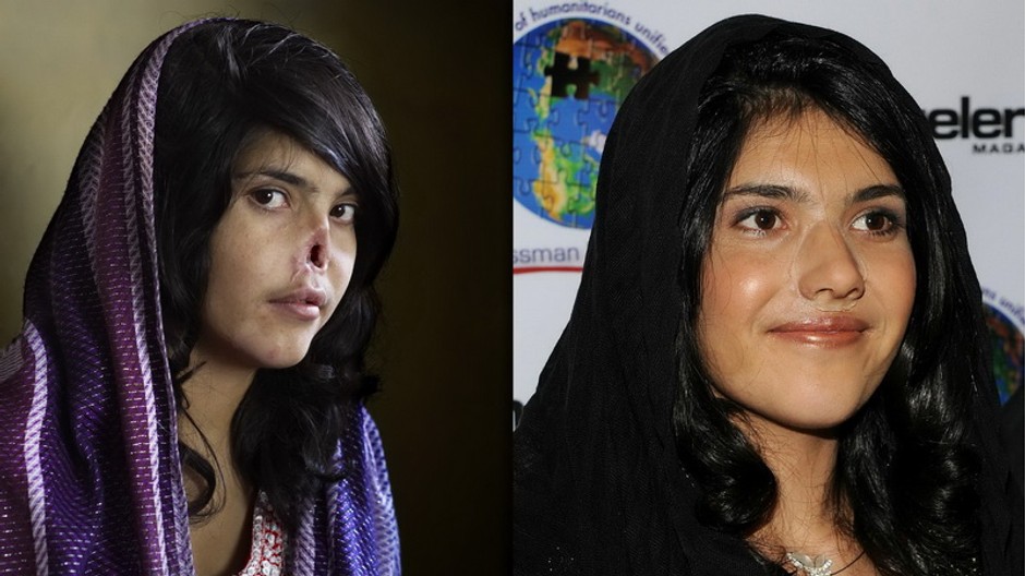 Fotografiou roka znetvorená mladá žena z Afganistanu