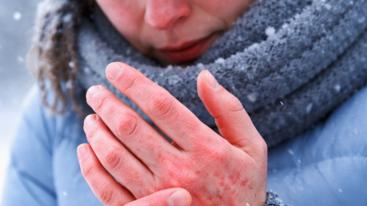 Trpíte v MRAZOCH viac než iní? 6 príznakov, že máte alergiu na chlad!