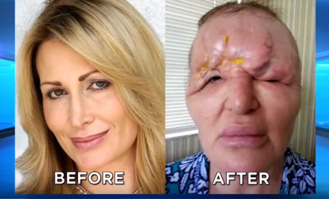 Američanka chcela spáchať samovraždu: Po plastike sa z krásky stalo monštrum!